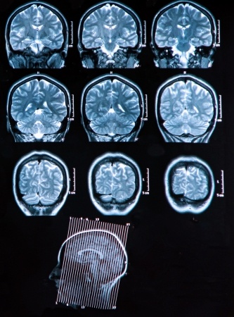 Ausbreitungsmechanismus von Parkinson bewiesen